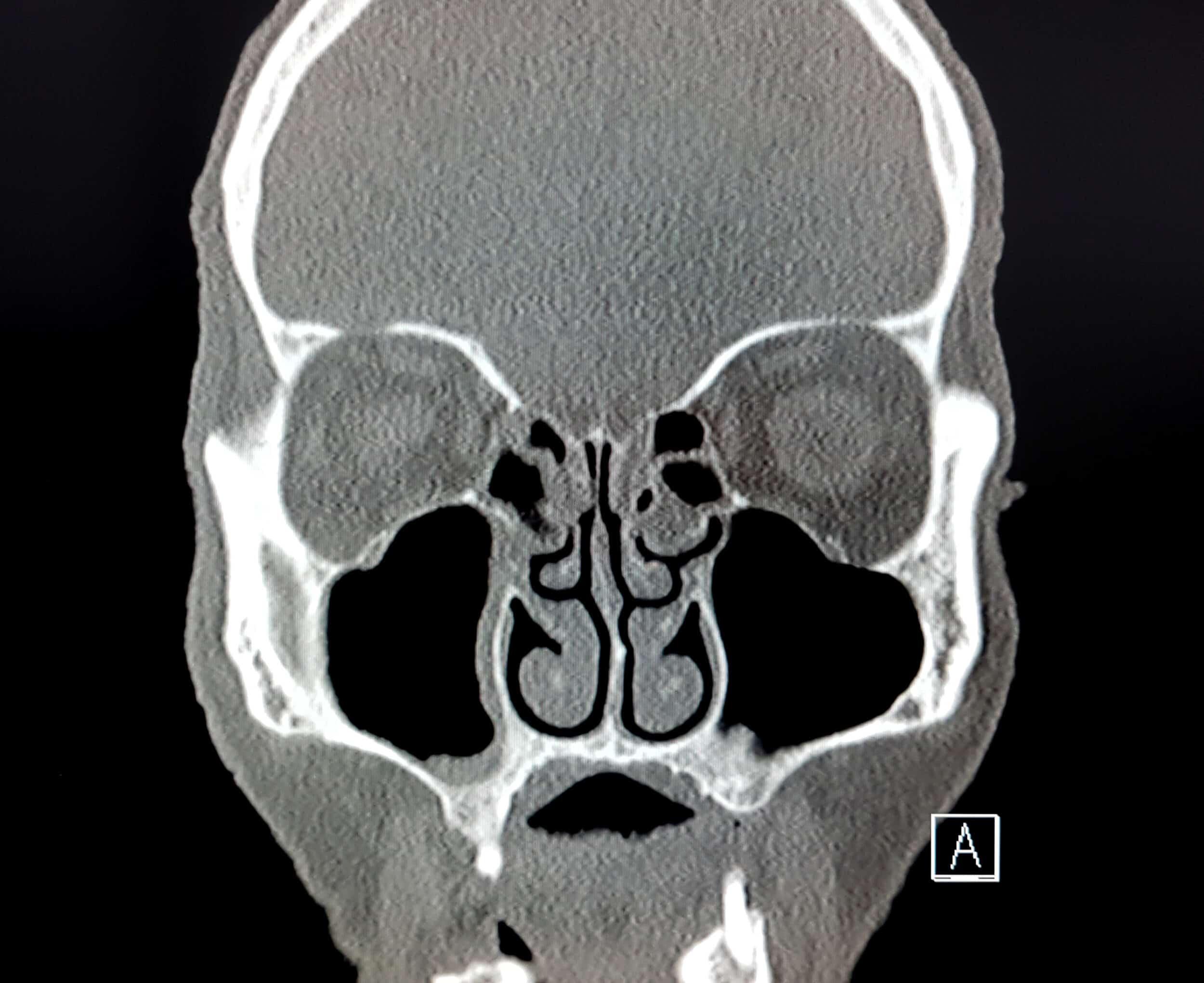 CT scan image of a man's sinus helps allow diagnosis for sinusitis