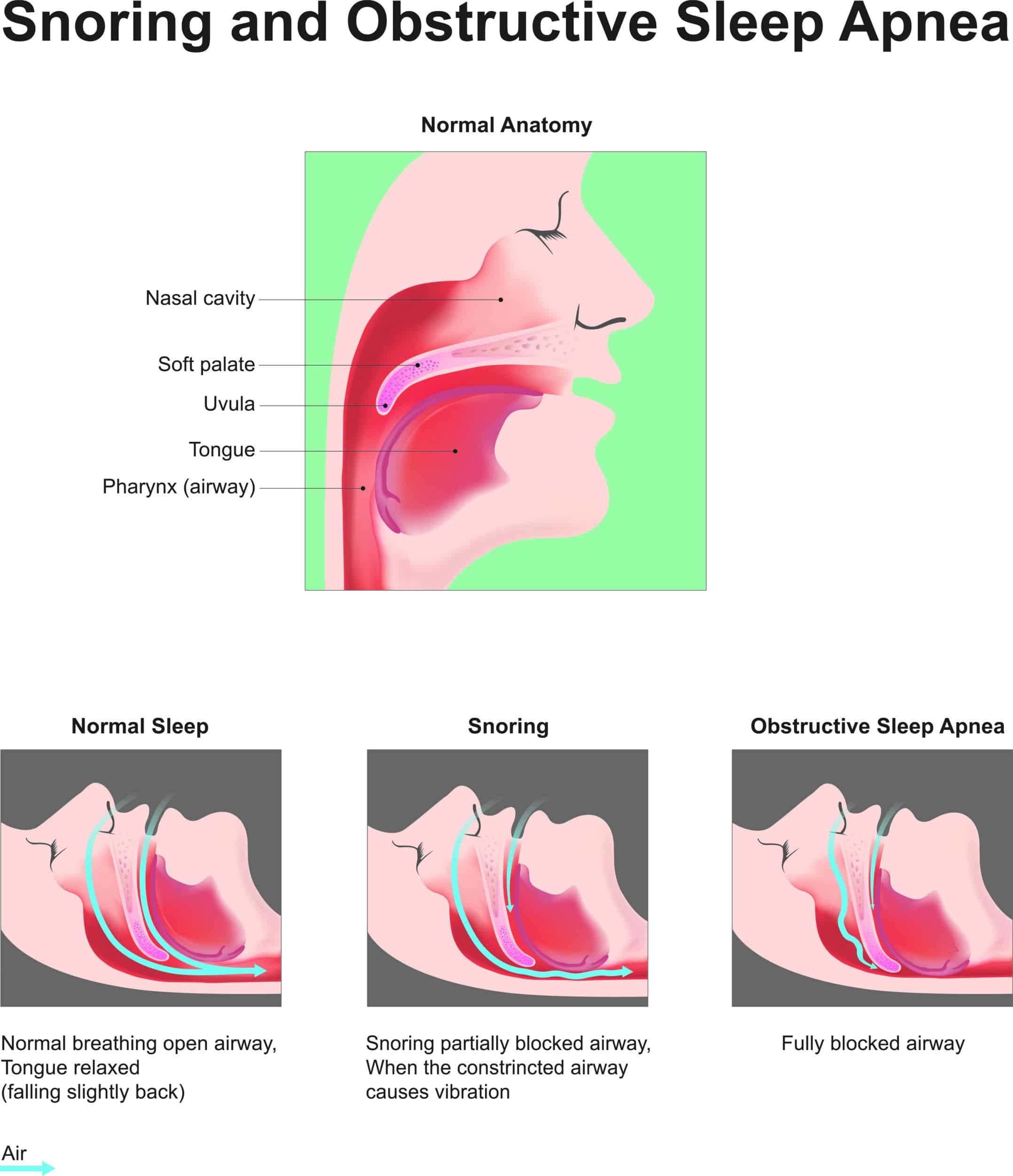 Snoring and sleep diagram