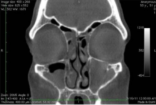Coronal view from a sinus CT scan