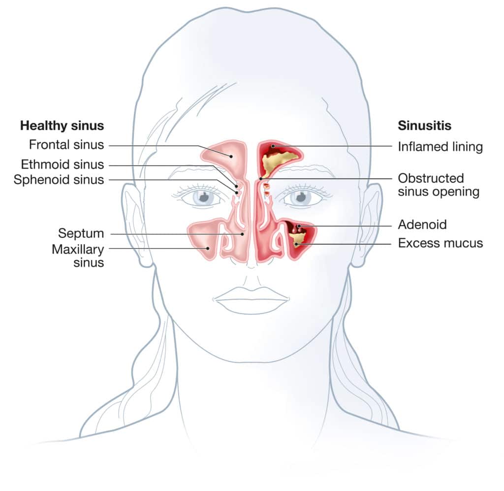 adobestock 333159238 1024x997 1 illustration of face with nose cross section, left side of nose healthy, right side of nose with sinusitis