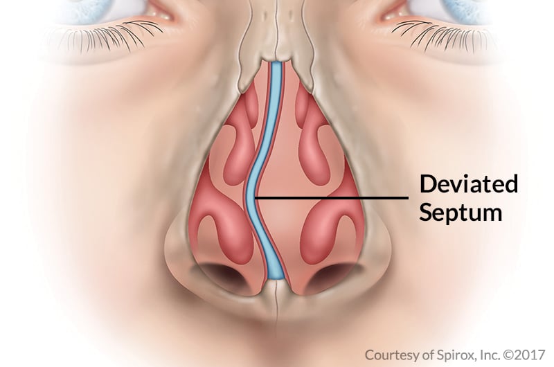 Nasal Septum Las Vegas NV Nasal Septum Las Vegas NV